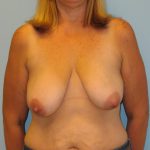 Patient 17 Before Breast Reduction Front View
