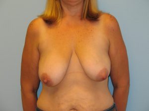 Patient 17 Before Breast Reduction Front View