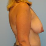 Patient 17 Before Breast Reduction Right View