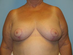 Patient 18 After Breast Reduction Front View