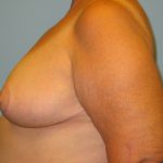 Patient 18 After Breast Reduction Left View