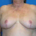 Patient 19 After Breast Reduction Front View