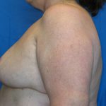 Patient 19 After Breast Reduction Left View