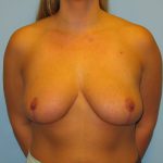 Patient 3 After Breast Reduction Front View