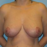 Patient 2 After Breast Reduction Front View