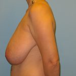 Patient 2 Before Breast Reduction Left View