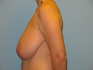 Patient 2 Before Breast Reduction Left View