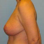 Patient 2 After Breast Reduction Left View