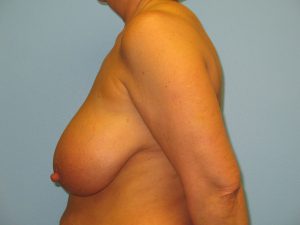 Patient 20 Before Breast Reduction Left View