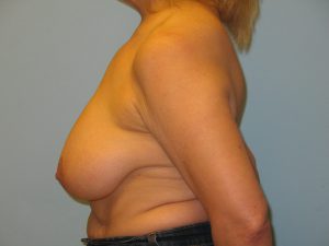 Patient 4 Before Breast Reduction Right View