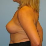 Patient 4 After Breast Reduction Right View