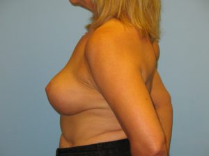 Patient 4 After Breast Reduction Right View