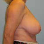 Patient 5 Before Breast Reduction Right View