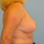 Patient 5 After Breast Reduction Right View