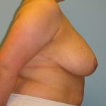 Patient 6 After Breast Reduction Right View