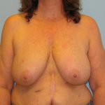 Patient 9 Before Breast Reduction Front View