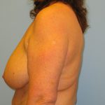 Patient 9 Before Breast Reduction Left View