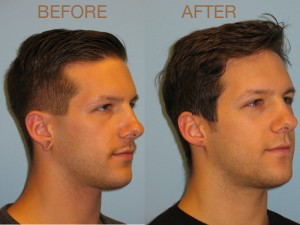 Patient 4 Otoplasty Before and After Right View