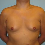 Patient 1 Before Gynecomastia Front View
