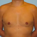 Patient 1 After Gynecomastia Front View