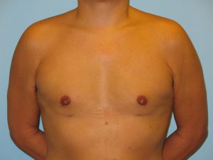 Patient 1 After Gynecomastia Front View