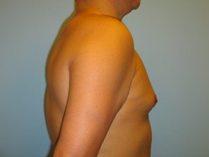 Patient 1 Before Gynecomastia Right Side View