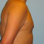 Patient 1 After Gynecomastia Right Side View