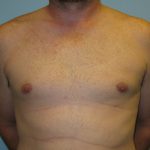 Patient 2 After Gynecomastia Front View