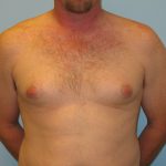 Patient 2 Before Gynecomastia Front View