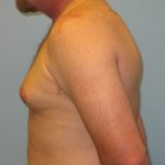 Patient 2 Before Gynecomastia Left Side View
