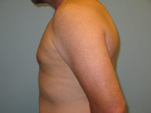 Patient 2 After Gynecomastia Left Side View