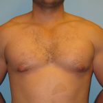 Patient 5 Before Gynecomastia Front View