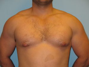 Patient 5 Before Gynecomastia Front View