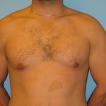 Patient 5 After Gynecomastia Front View