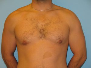 Patient 5 After Gynecomastia Front View