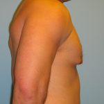 Patient 5 Before Gynecomastia Right Side View