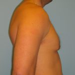 Patient 5 After Gynecomastia Right Side View