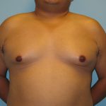 Patient 6 Before Gynecomastia Front View
