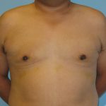 Patient 6 After Gynecomastia Front View
