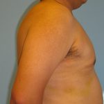 Patient 6 After Gynecomastia Right Side View