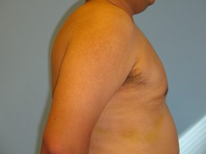 Patient 6 After Gynecomastia Right Side View