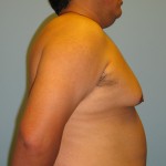 Patient 6 Before Gynecomastia Right Side View