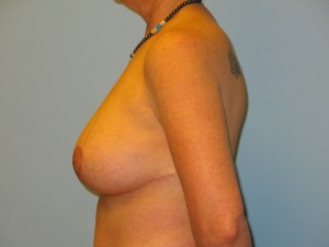 Patient with Celtic Tattoo After Breast Surgery Left View Copy