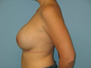 Patient 21 After Breast Augmentation Left View