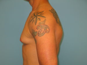 Patient 7 Before Gynecomastia Left Side View