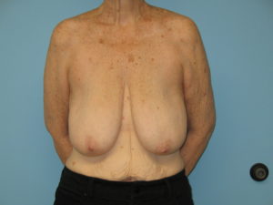 Patient 21 Before Breast Reduction Front View