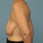 Patient 21 Before Breast Reduction Left View