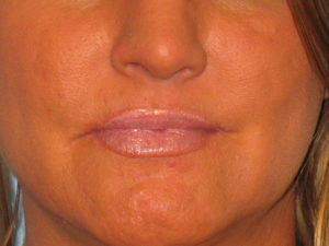 Patient 7 After Facial Surgery