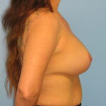 Breast Augmentation Recovery