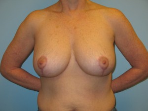 Patient with Celtic Tattoo After Breast Surgery Front View